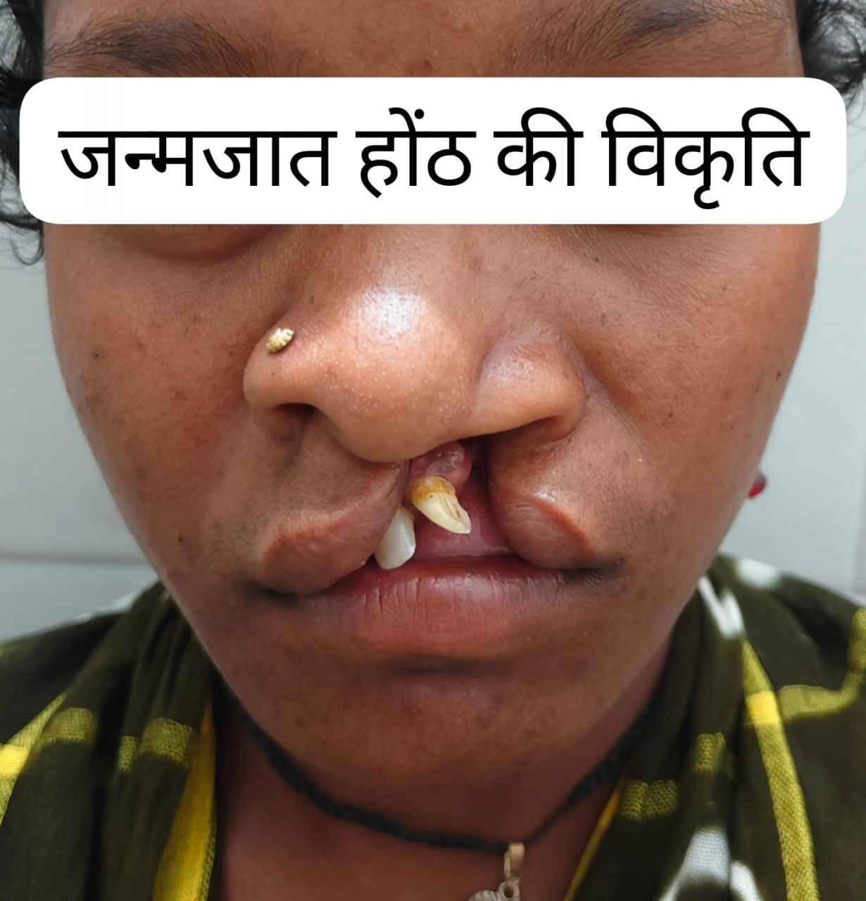 सफल सर्जरी से भीमे हेमला के चेहरे पर लौटी मुस्कान, जन्मजात होंठ की विकृति का हुआ सफल उपचार